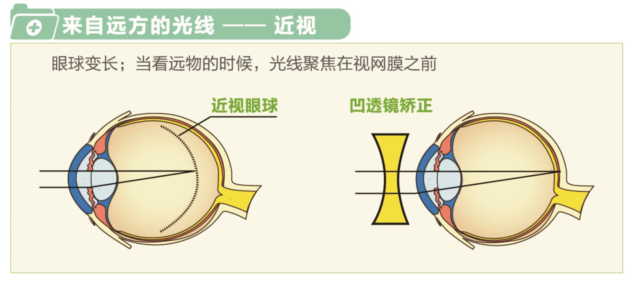 近视.jpg